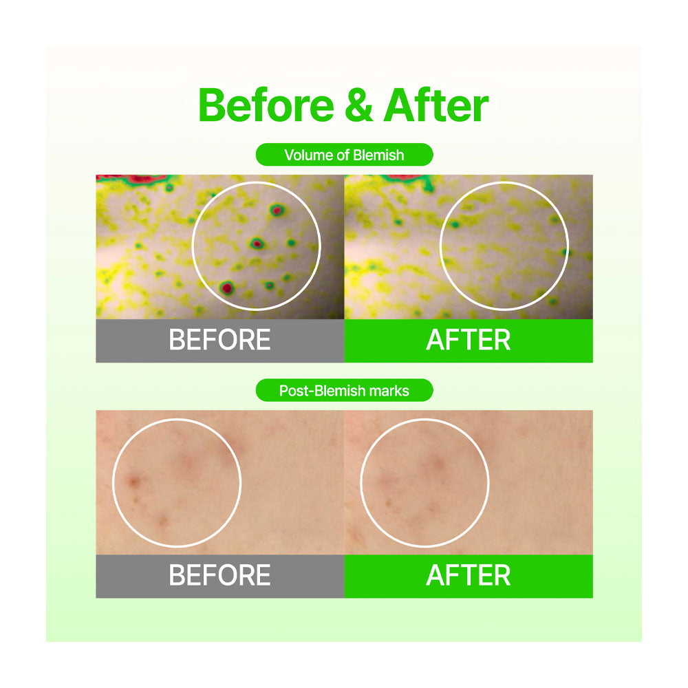 ACROPASS Dark Spot Care Microcone Patch - Peaches&Creme Shop Korean Skincare Malta