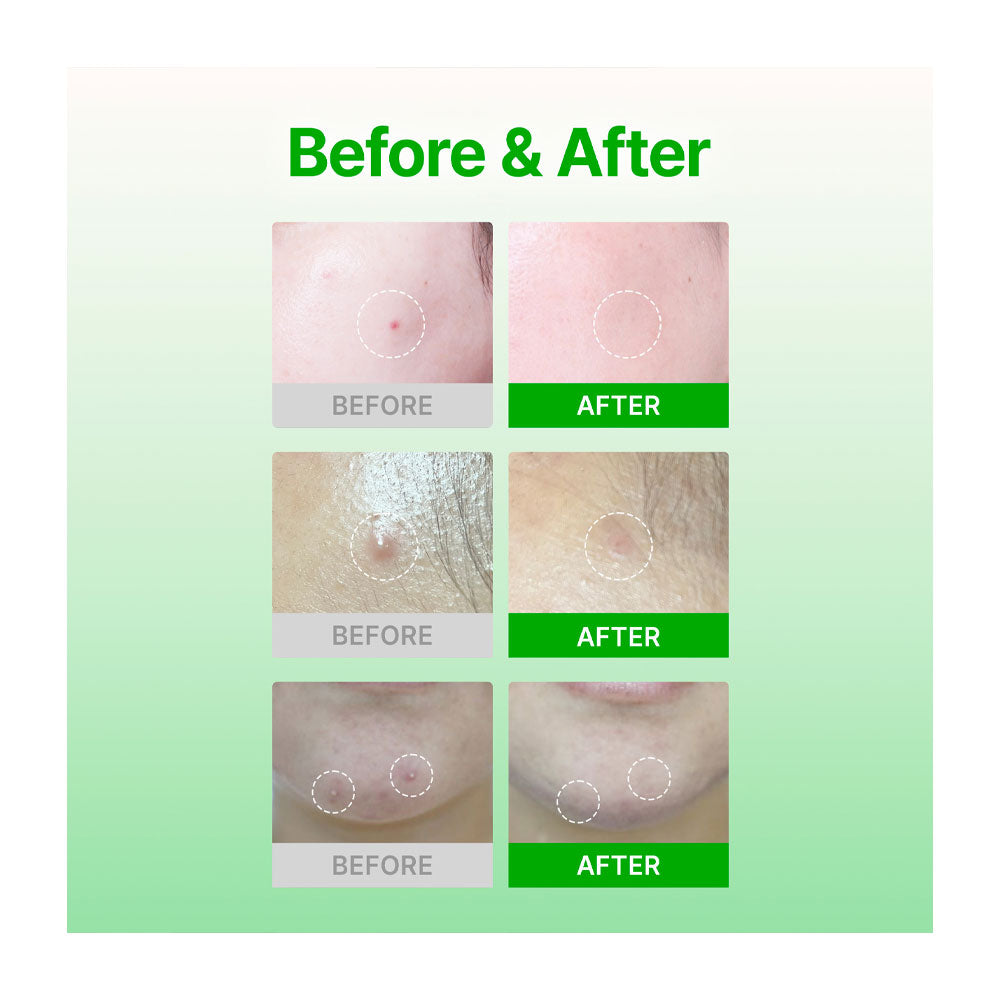 ACROPASS Trouble Care Microcone Patch - Peaches&Creme Shop Korean Skincare Malta