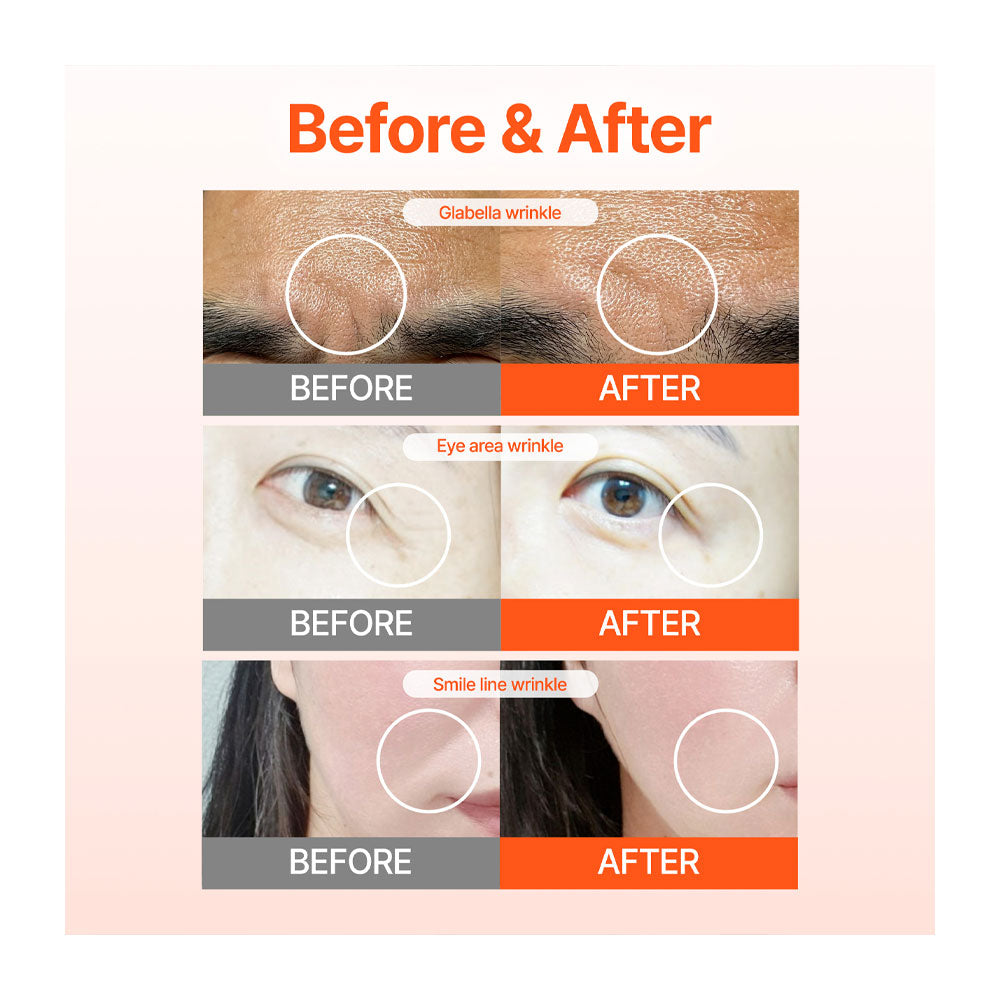 ACROPASS Reti-RN Microcone Patch - Peaches&Creme Shop Korean Skincare Malta