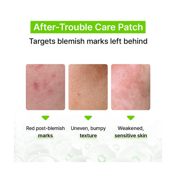 ACROPASS Blemish Care Microcone Patch - Peaches&Creme Shop Korean Skincare Malta