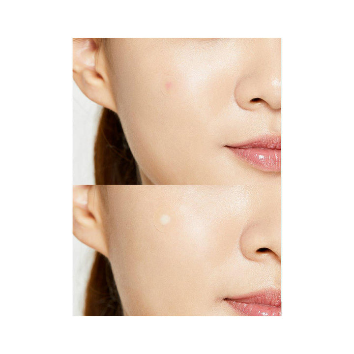 Acne Pimple Master Patch - Peaches&Creme Shop Korean Skincare Malta
