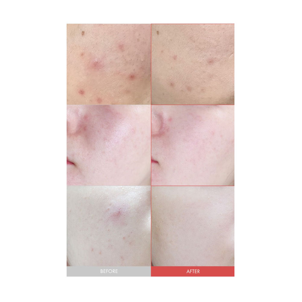 DR.CEURACLE Azelaic10 & Madeca Ampoule - Peaches&Creme Shop Korean Skincare Malta