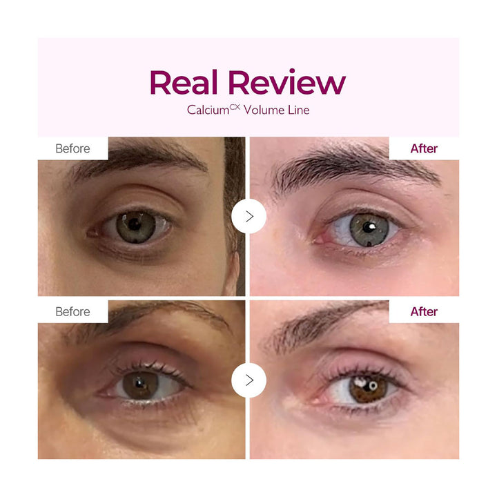 Before and after comparison of eye area treatment with &
