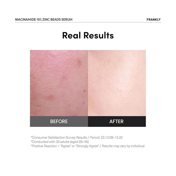 FRANKLY Niacinamide 15% Zinc Beads Serum - Peaches&Creme Shop Korean Skincare Malta