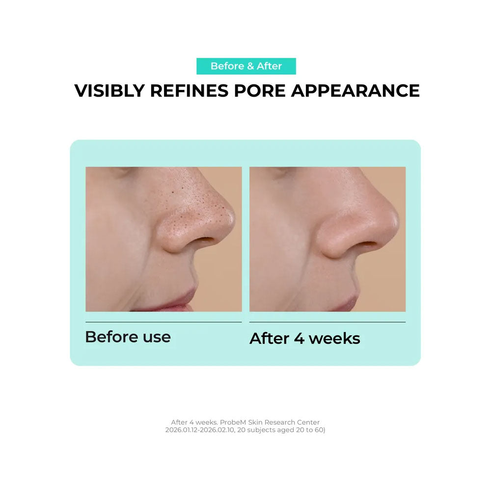 Before and after comparison of skin refinement with visible pore reduction on a person&
