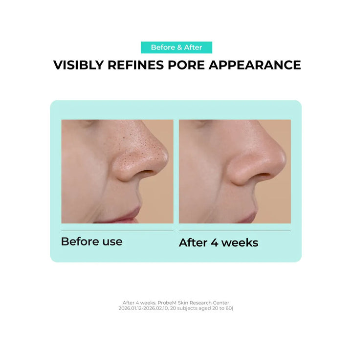 Before and after comparison of skin refinement with visible pore reduction on a person&