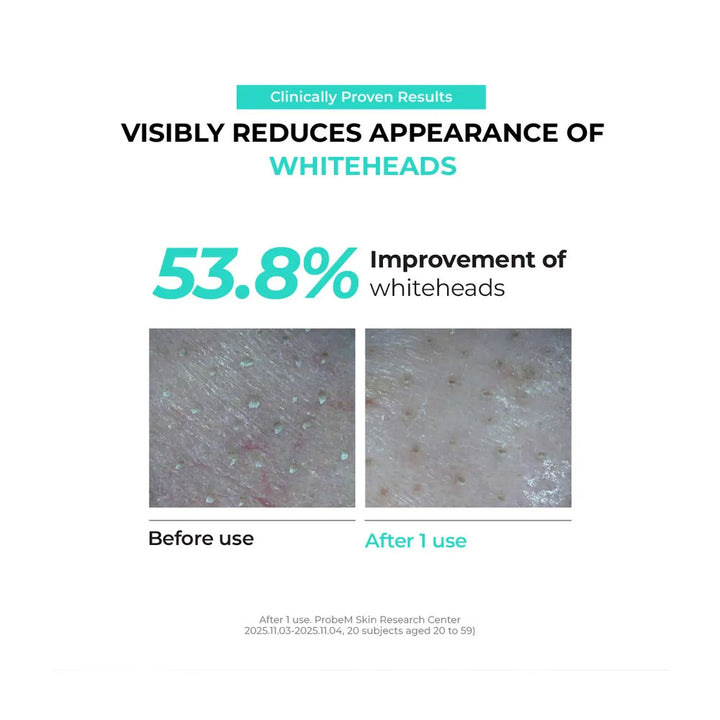 Advertisement showing before and after effects of a skincare product on whiteheads with text about clinical proven results.