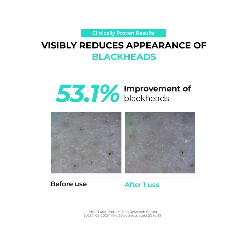Advertisement showing before and after effects of a blackhead removal product with clinical data.
