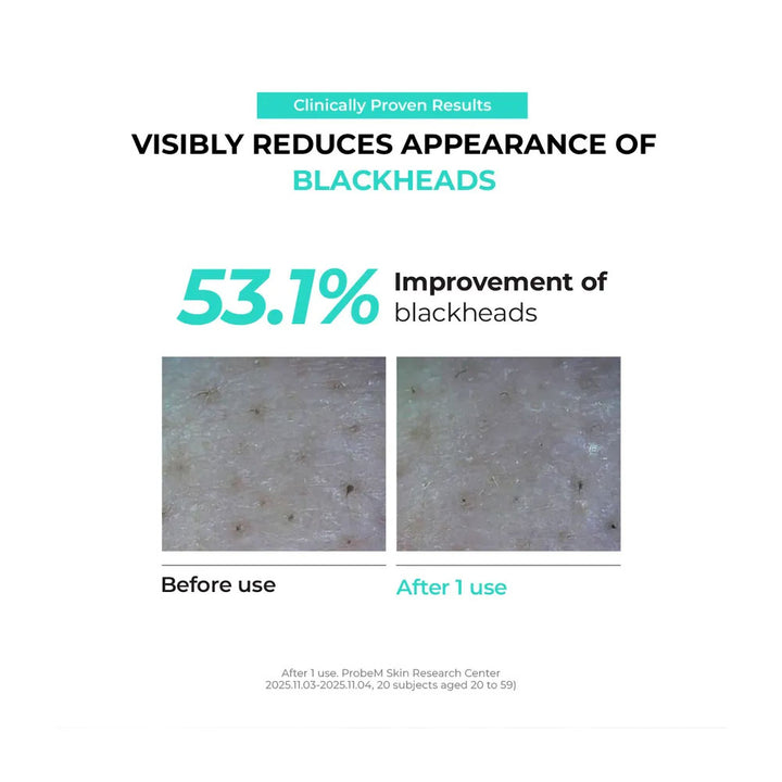 Advertisement showing before and after effects of a blackhead removal product with clinical data.