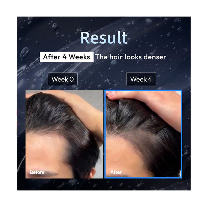 Before and after comparison of hair density after 4 weeks, showing a denser hair appearance.