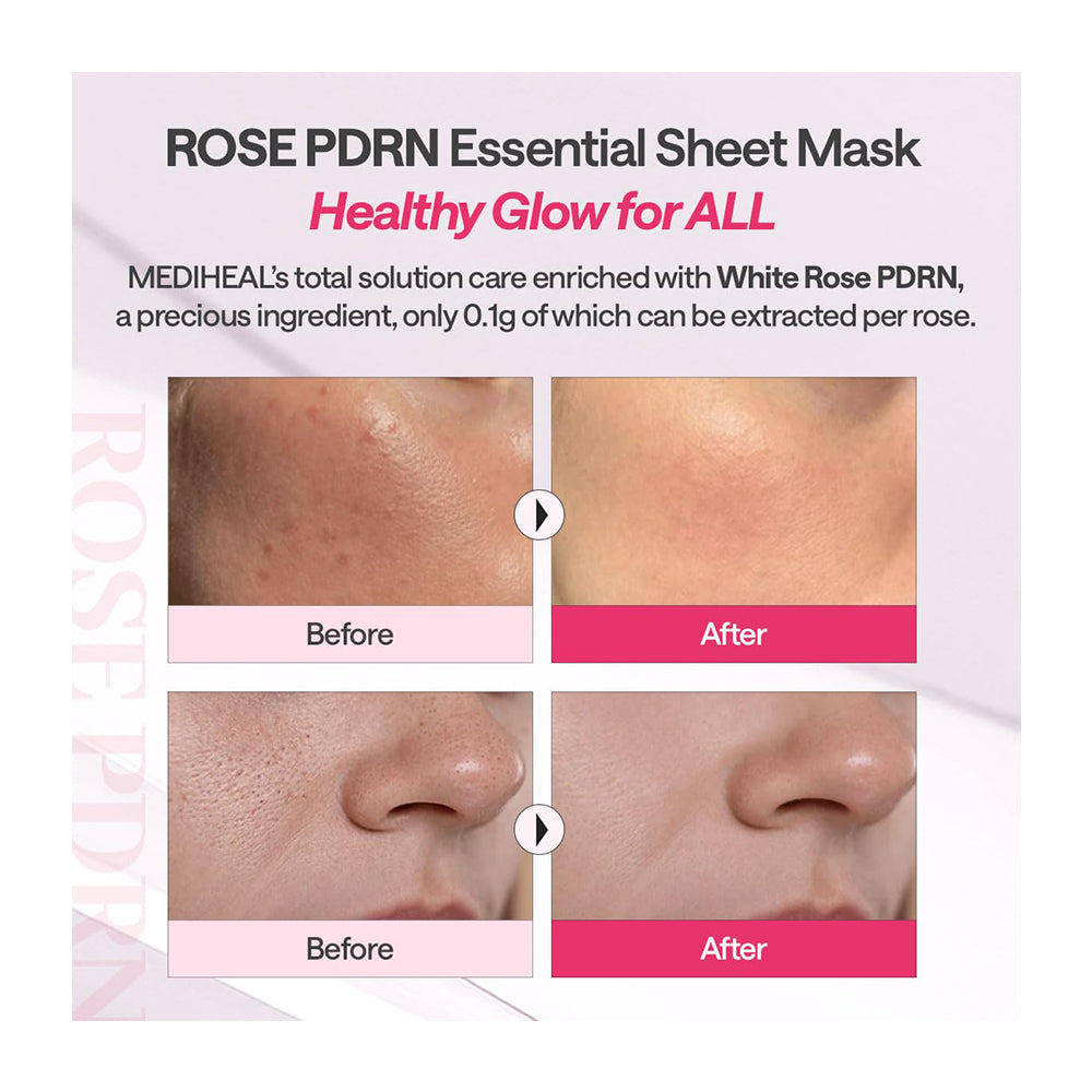 Promotional graphic for a ROSE PDRN Essential Sheet Mask, showing before-and-after skin close-ups with text describing MediHeal&
