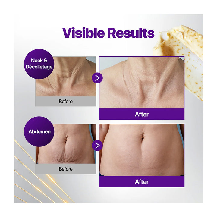 Before-and-after comparison graphic showing visible skin tightening results on a neck and abdomen, with purple text reading &