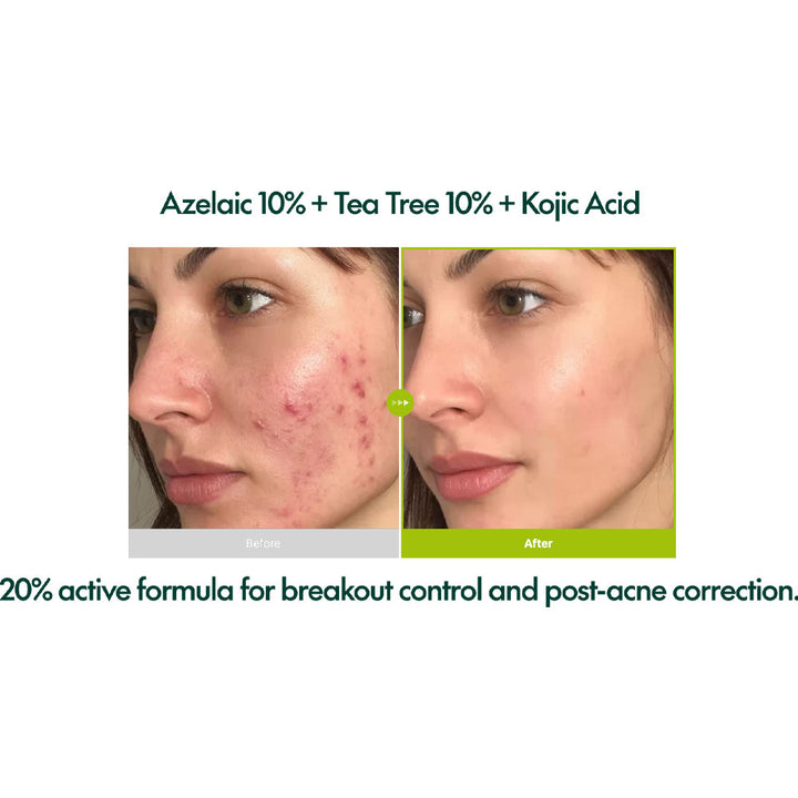 PURITO SEOUL Azelaic Acid 10 Kojic Tea Tree Serum - Peaches&Creme Shop  Korean Skincare Malta