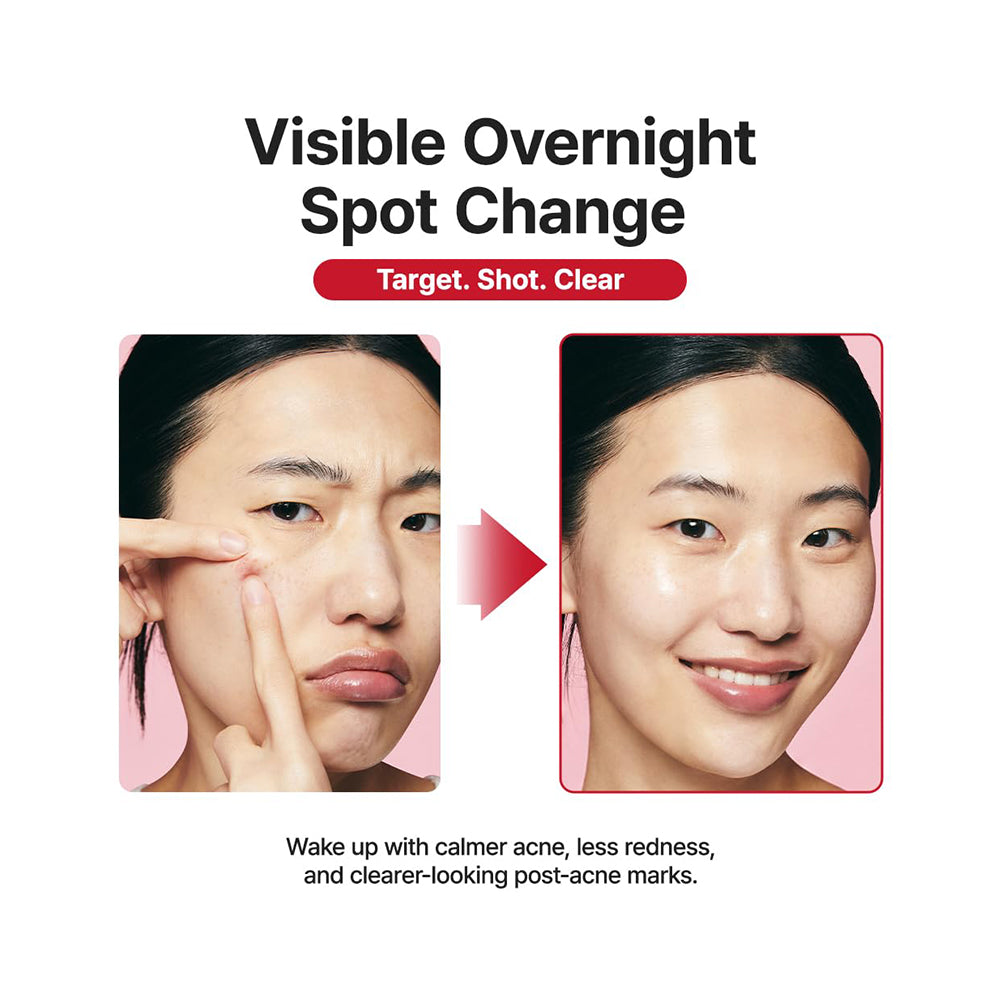 Promotional graphic for a skincare product showing before-and-after facial close-ups of an Asian woman with acne marks, with text reading &