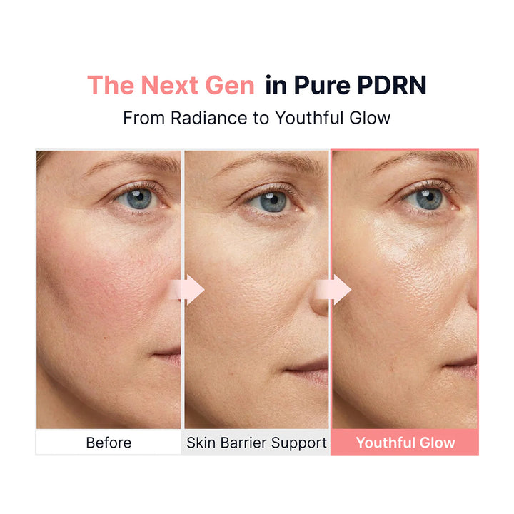 Before and after comparison of skin with Pure PDRN, showing radiance to youthful glow.